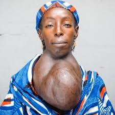 goiter patient
